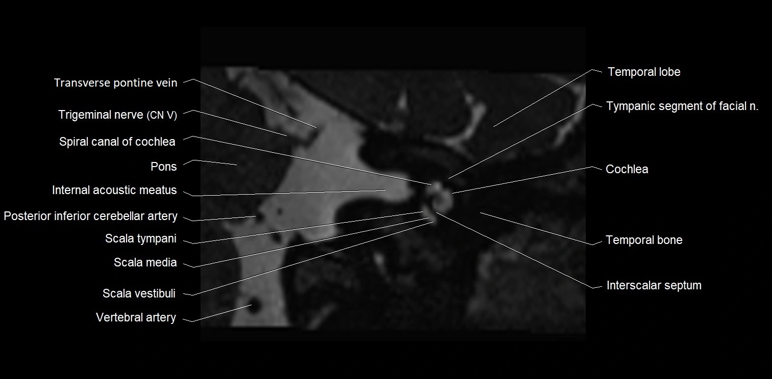 MRI Internal auditory meatus (IAM) coronal cross sectional labelled anatomy image 6.webp